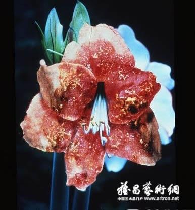 马特-科里肖-转移性恶性黑色素瘤 mat collishaw metastases